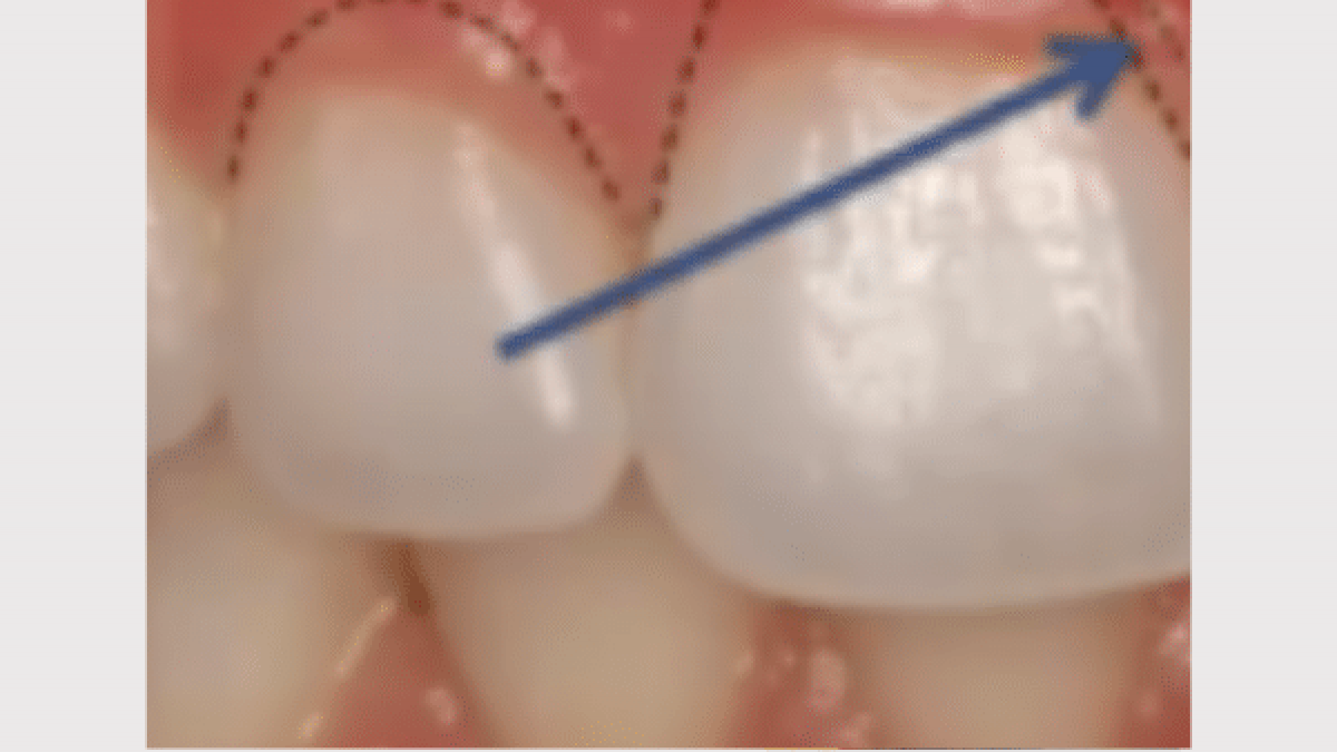 image of a tooth and gum