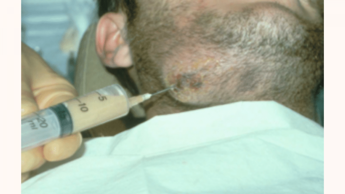 Image of patient having liquid build up removed from an infection in the jaw area.