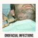 Image of patient having liquid build up removed from an infection in the jaw area.
